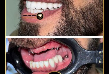 أفضل دكتور زراعة رقمية في طهران