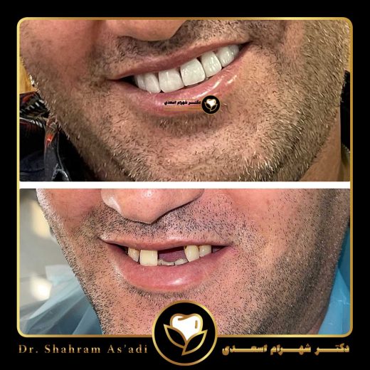 لمینت دندان